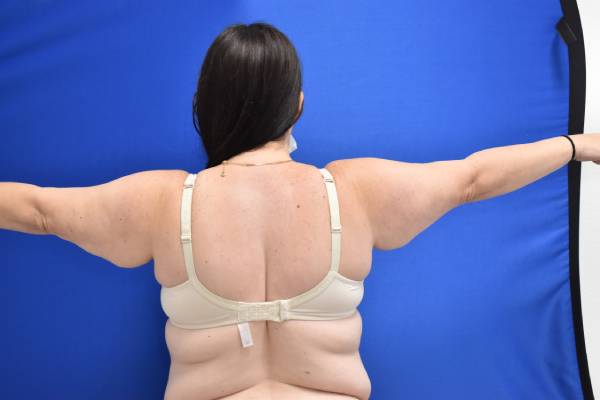 before Arm Lift female patient back angle view Case 1149