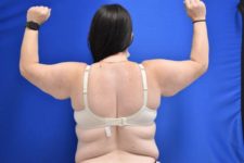 before Arm Lift female patient back angle view Case 1149