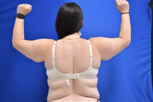 before Arm Lift female patient back angle view Case 1149