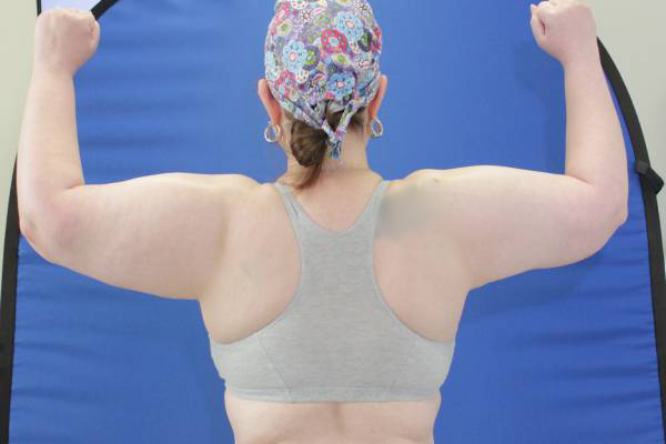 after arm lift female patient back view case 1144