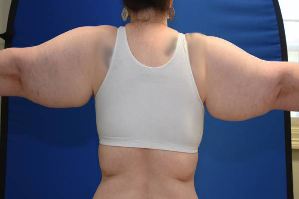 before arm lift female patient back view case 1144