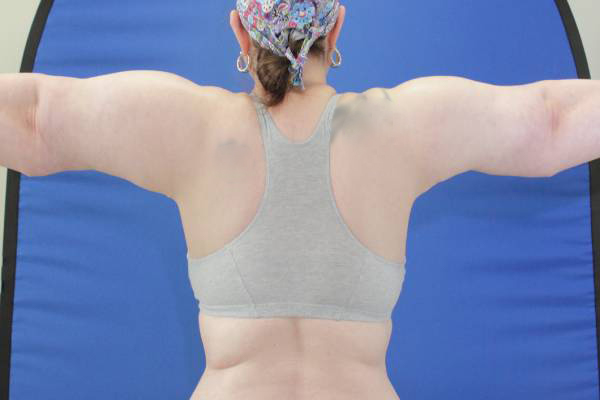 after arm lift female patient back view case 1144