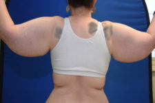 before arm lift female patient back view case 1144