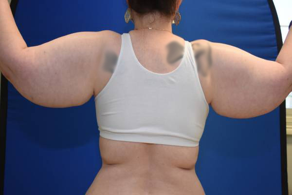 before arm lift female patient back view case 1144