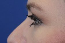 after Blepharoplasty Eyelid Surgery zoomed side view Case 678