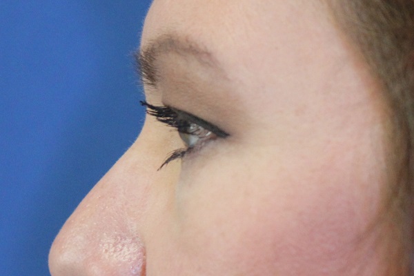 before Blepharoplasty Eyelid Surgery zoomed side view Case 678