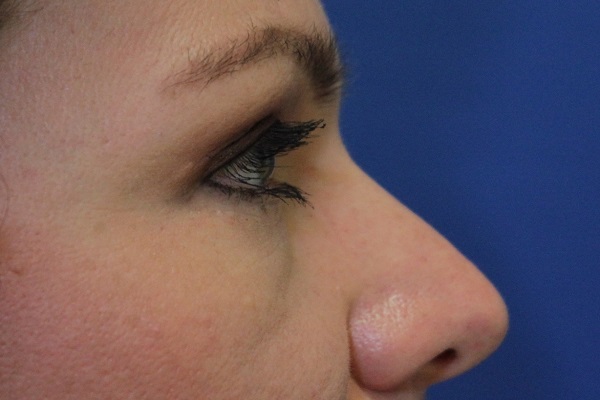 after Blepharoplasty Eyelid Surgery zoomed side view Case 678