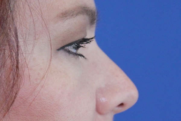 before Blepharoplasty Eyelid Surgery zoomed side view Case 678