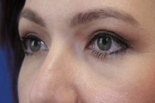 after Blepharoplasty Eyelid Surgery zoomed diagonal view Case 678