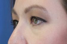 before Blepharoplasty Eyelid Surgery zoomed diagonal view Case 678