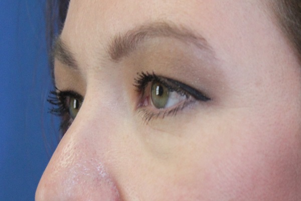 before Blepharoplasty Eyelid Surgery zoomed diagonal view Case 678