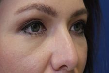 after Blepharoplasty Eyelid Surgery zoomed diagonal view Case 678