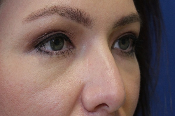 after Blepharoplasty Eyelid Surgery zoomed diagonal view Case 678