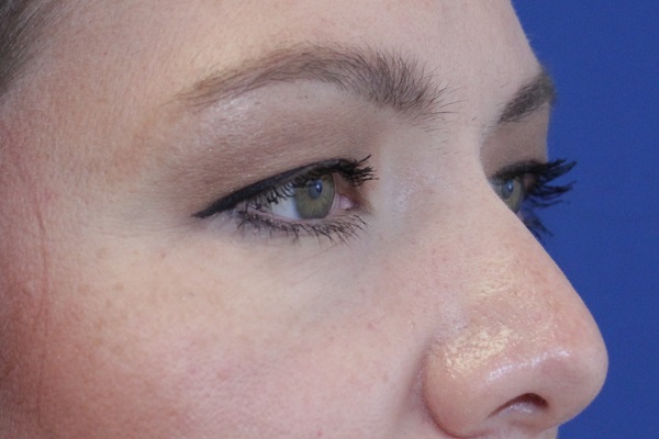 before Blepharoplasty Eyelid Surgery zoomed diagonal view Case 678