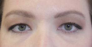 before Blepharoplasty Eyelid Surgery zoomed view Case 678