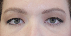 before Blepharoplasty Eyelid Surgery zoomed view Case 678
