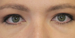 after Blepharoplasty Eyelid Surgery zoomed view Case 678