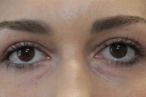 after Blepharoplasty Eyelid Surgery front zoomed view Case 689