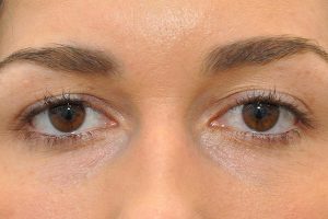 before Blepharoplasty Eyelid Surgery front zoomed view Case 689