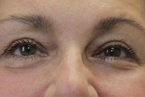 after Blepharoplasty Eyelid Surgery front zoomed view Case 700