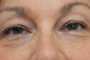 before Blepharoplasty Eyelid Surgery front zoomed view Case 700