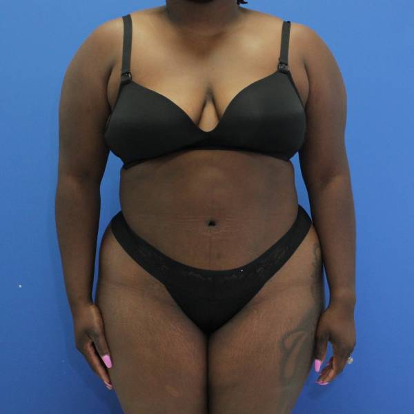after Brazilian Butt Lift Case front view 932