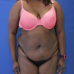 before Brazilian Butt Lift Case front view 932