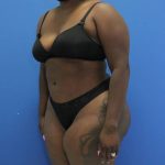 after Brazilian Butt Lift Case diagonal view 932
