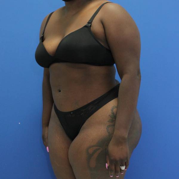 after Brazilian Butt Lift Case diagonal view 932