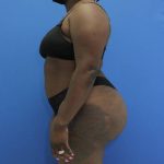 after Brazilian Butt Lift Case side view 932