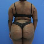 after Brazilian Butt Lift Case back view 932