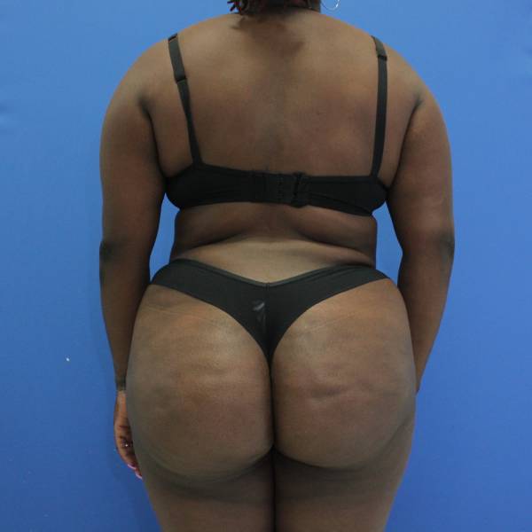 after Brazilian Butt Lift Case back view 932