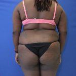 before Brazilian Butt Lift Case back view 932