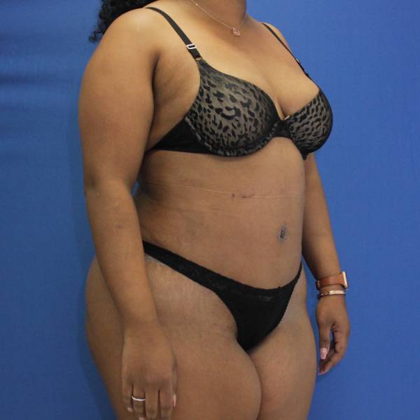 after Brazilian Butt Lift Case diagonal view 941