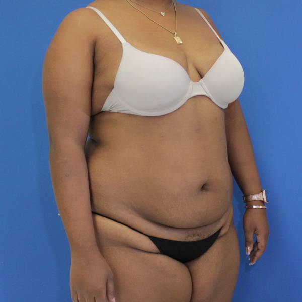 before Brazilian Butt Lift Case diagonal view 941