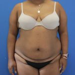 before Brazilian Butt Lift Case front view 941