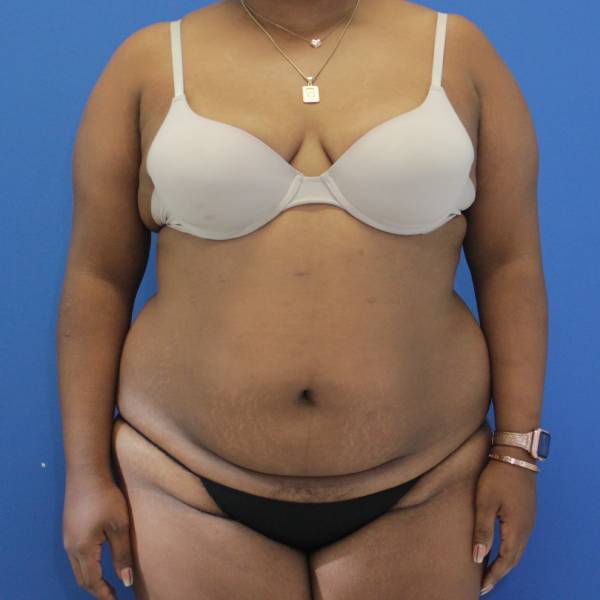before Brazilian Butt Lift Case front view 941
