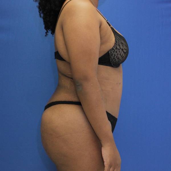after Brazilian Butt Lift Case side view 941