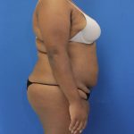 before Brazilian Butt Lift Case side view 941