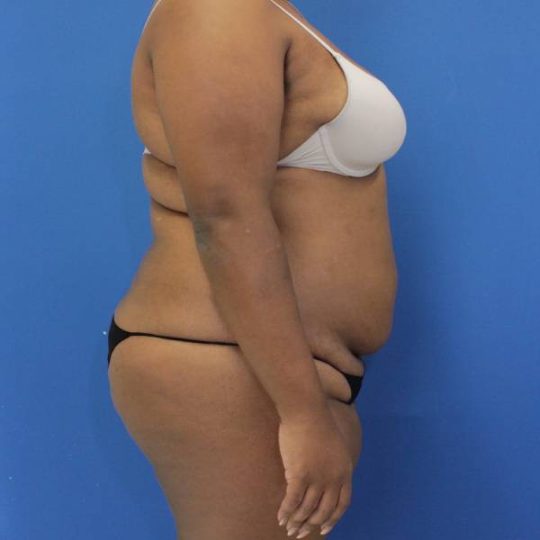 before Brazilian Butt Lift Case side view 941