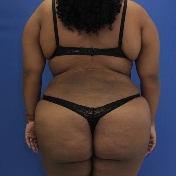 after Brazilian Butt Lift Case back view 941
