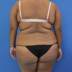 before Brazilian Butt Lift Case back view 941