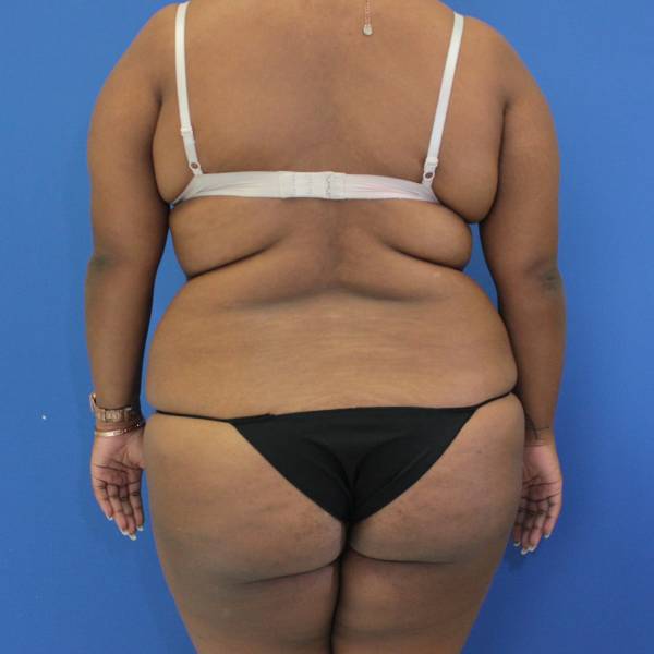 before Brazilian Butt Lift Case back view 941