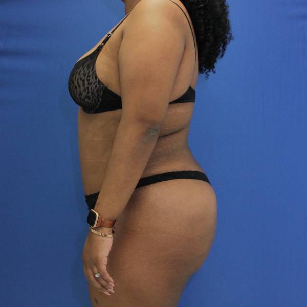 after Brazilian Butt Lift Case side view 941