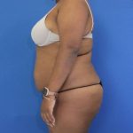 before Brazilian Butt Lift Case side view 941