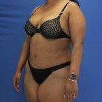 after Brazilian Butt Lift Case diagonal view 941