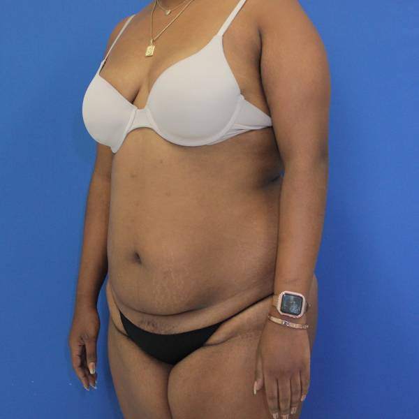 before Brazilian Butt Lift Case diagonal view 941