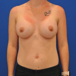 after breast augmentation front view female patient case 1422