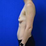 before breast augmentation left side female patient case 1422