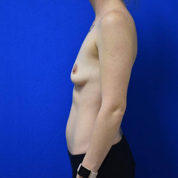 before breast augmentation left side female patient case 1422
